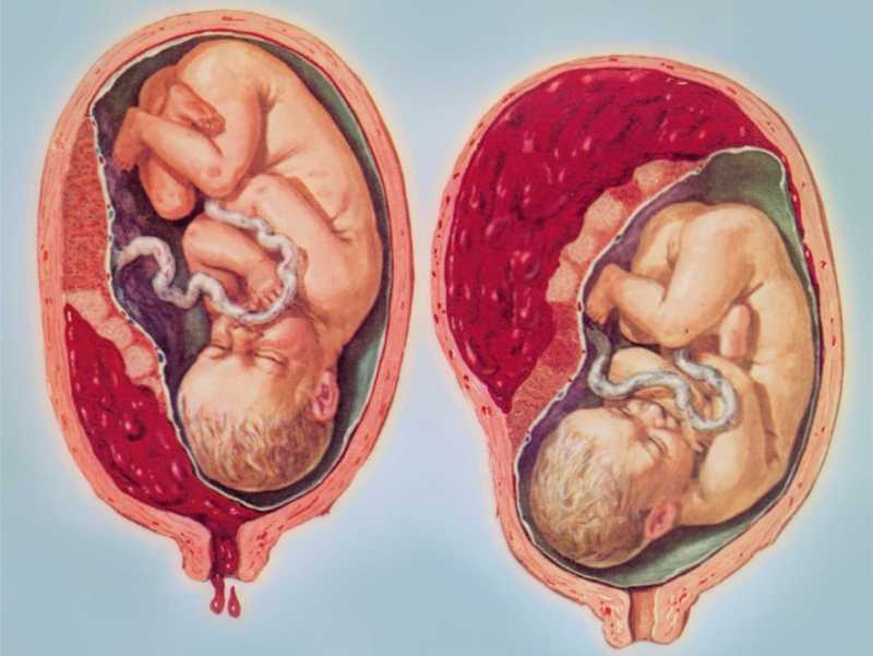 Что означает предлежание плаценты по передней стенке матки и на что оно влияет?
