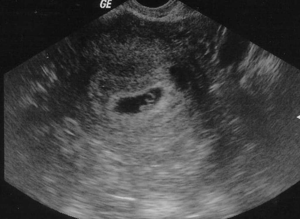 Плод на 12 неделе беременности фото узи как выглядит