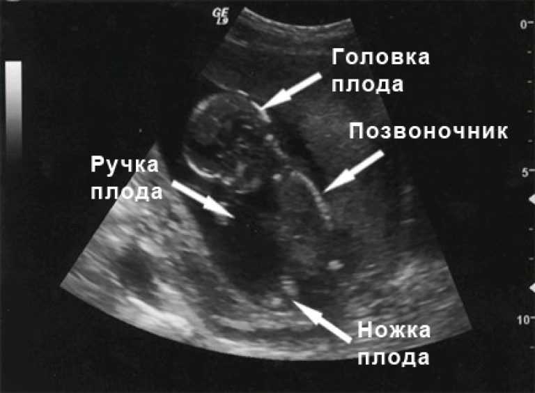 Расшифровка узи на 12-13 неделе беременности